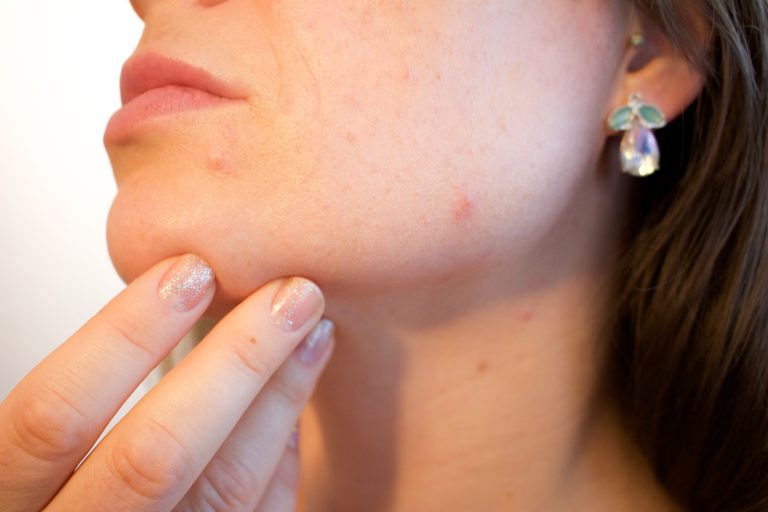 Paleo Diet and Acne